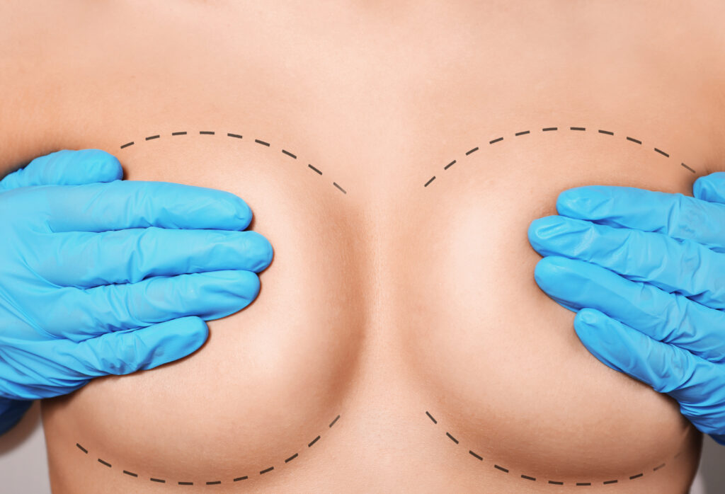 breast reduction