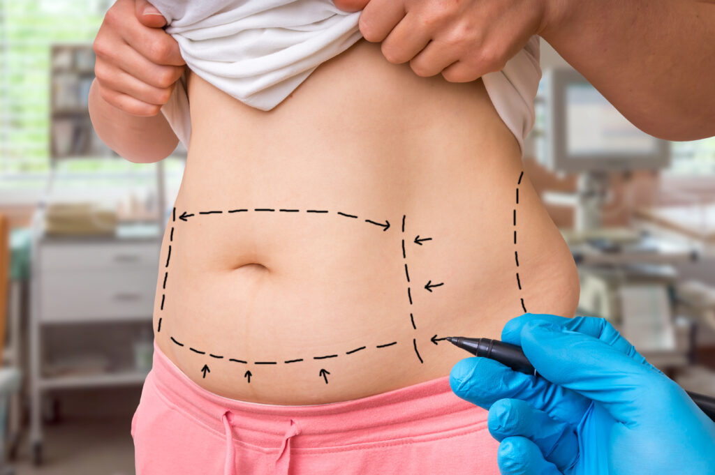 liposuction